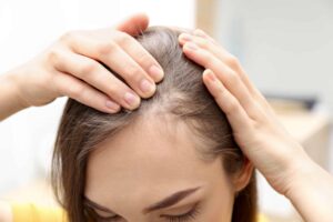 close up of young woman parting hair to show hair loss