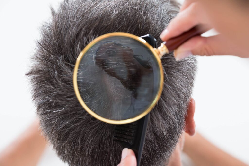 close up of hand holding a magnifying glass to examine the scalp of a person with short brown hair