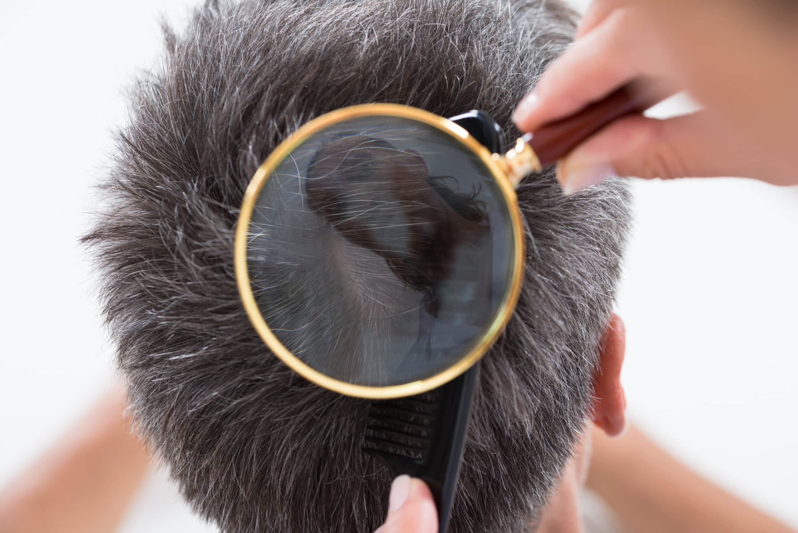 close up of hand holding a magnifying glass to examine the scalp of a person with short brown hair