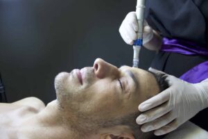 close up of man lying down with eyes closed as he received microneedling on his hairline from gloved hands
