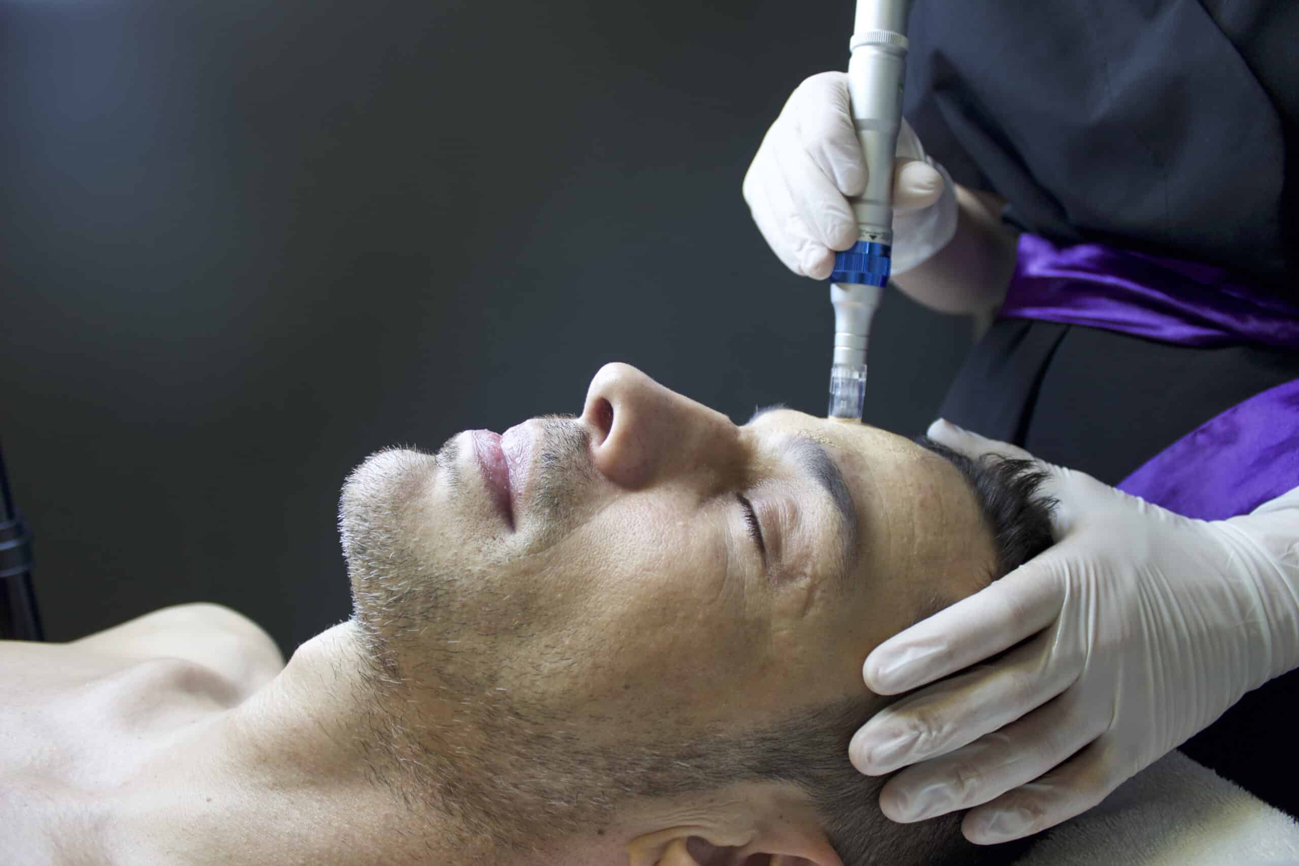 close up of man lying down with eyes closed as he received microneedling on his hairline from gloved hands