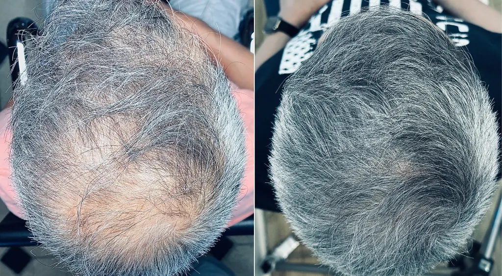 H-Shot hair restoration before and after results (patient 2)