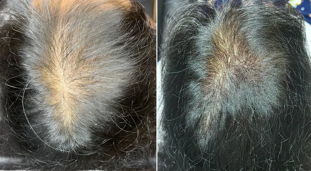 H-Shot hair restoration before and after results (patient 4)