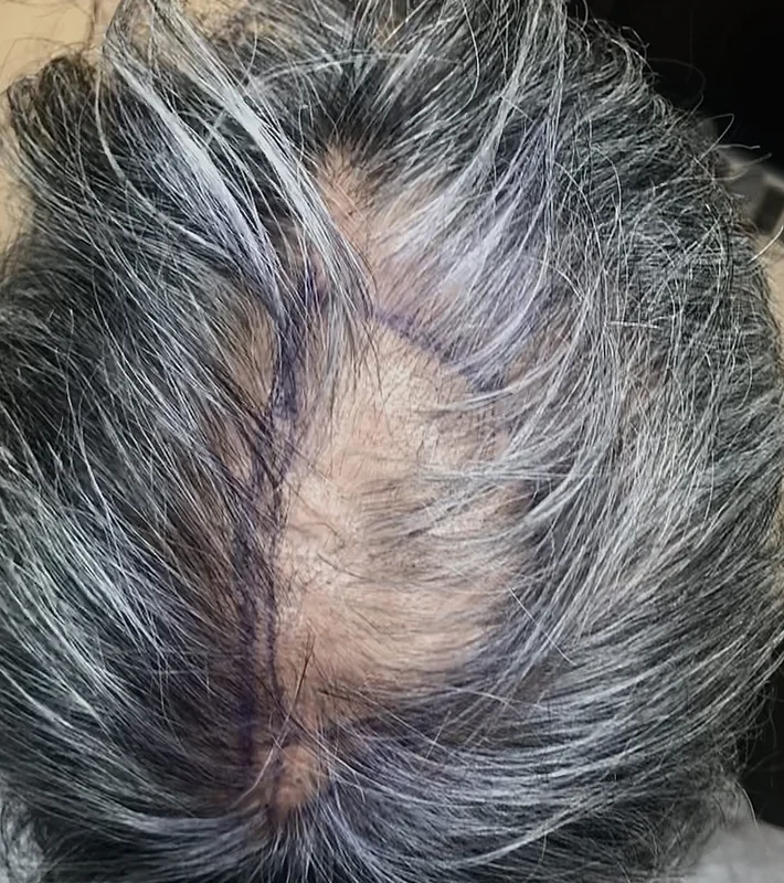 H-Shot hair restoration results, before treatment