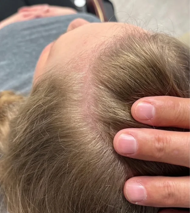 H-Shot hair restoration results, after treatment
