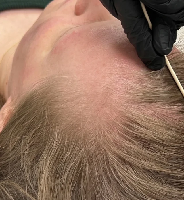 H-Shot hair restoration results, before treatment