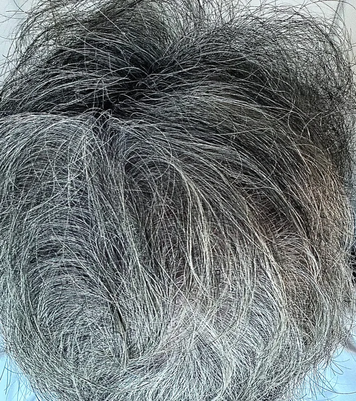 H-Shot hair restoration results, after treatment
